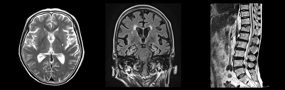 Mri ステント ステント挿入 他の検査可能か