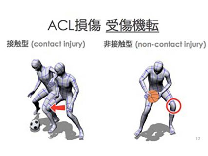 戸畑共立病院 整形外科 前十字靭帯断裂の治療